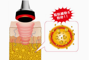 皮下脂肪をターゲットと
